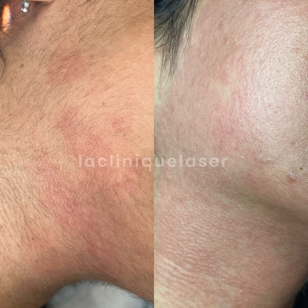 Avant / après bleaching visage