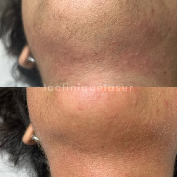 Avant / après bleaching visage