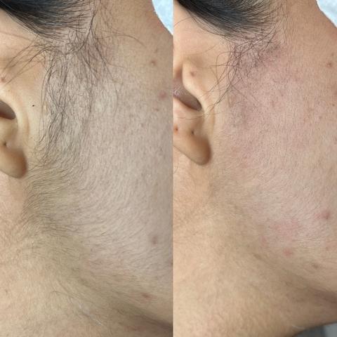 Avant / après bleaching favoris