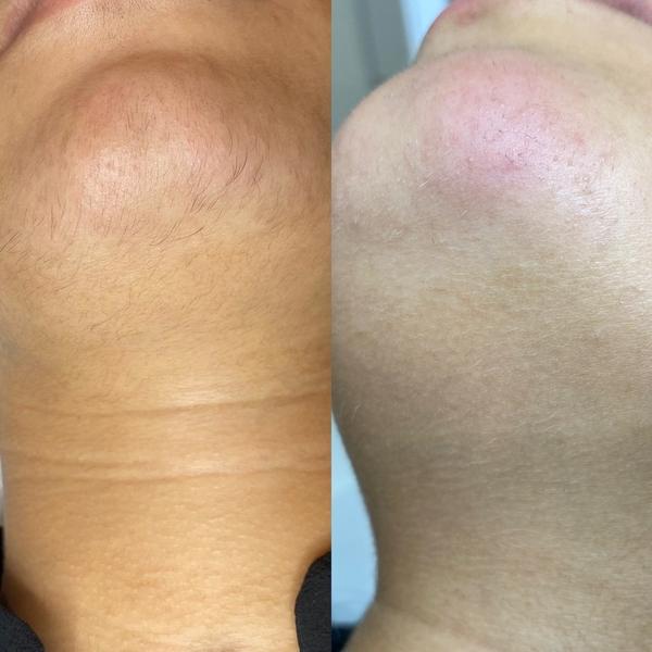 Avant / après bleaching visage