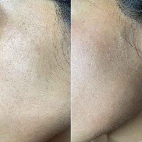 Avant / après bleaching visage
