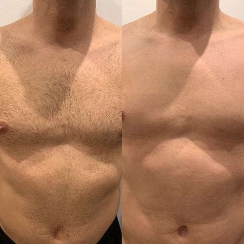 Epilation laser homme Nice Marseille