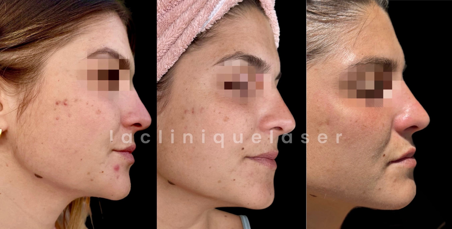 Microneedling hydroderma La Clinique Laser