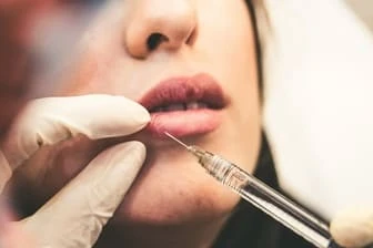 L'injection pour repulper vos lèvres - Clinique Nice