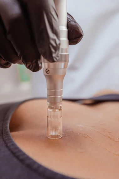 Microneedling médicalisé à La Clinique Laser