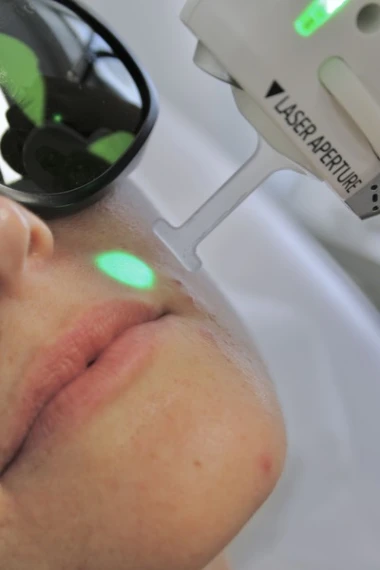 Tout savoir sur l'épilation laser à Marseille et Nice