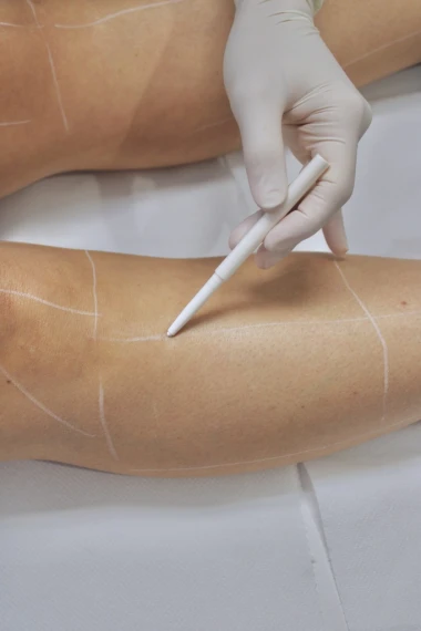 Diagnostic de peau avant épilation laser : sécurité & résultats