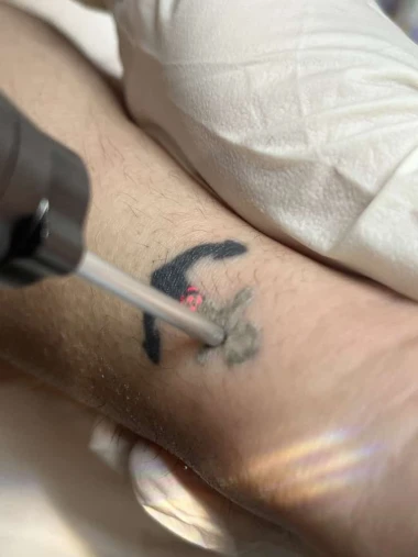 Le laser efficace pour enlever un tatouage
