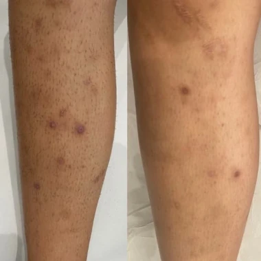 Nos solutions pour les poils incarnés par épilation laser