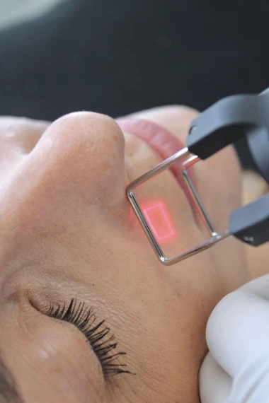 Laser fractionné non ablatif ou CO₂ : quelles différences ?