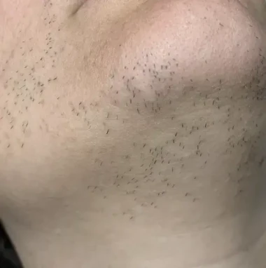 Epilation lumiere pulsée marseille clinique laser