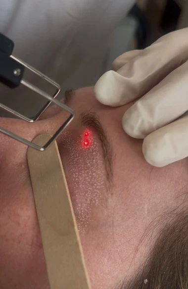 Resurfaçage au laser CO2 Marseille