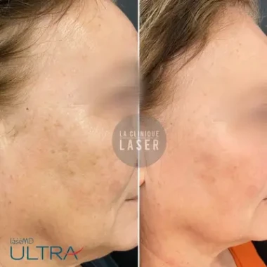 Les lasers fractionnés non ablatifs | La Clinique Laser Marseille