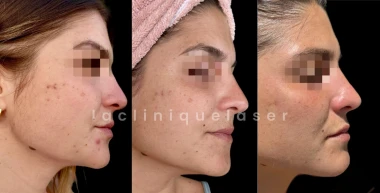 Microneedling à Marseille & Nice : résultats et conseils médicaux