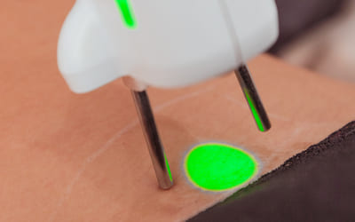 epilation laser nice