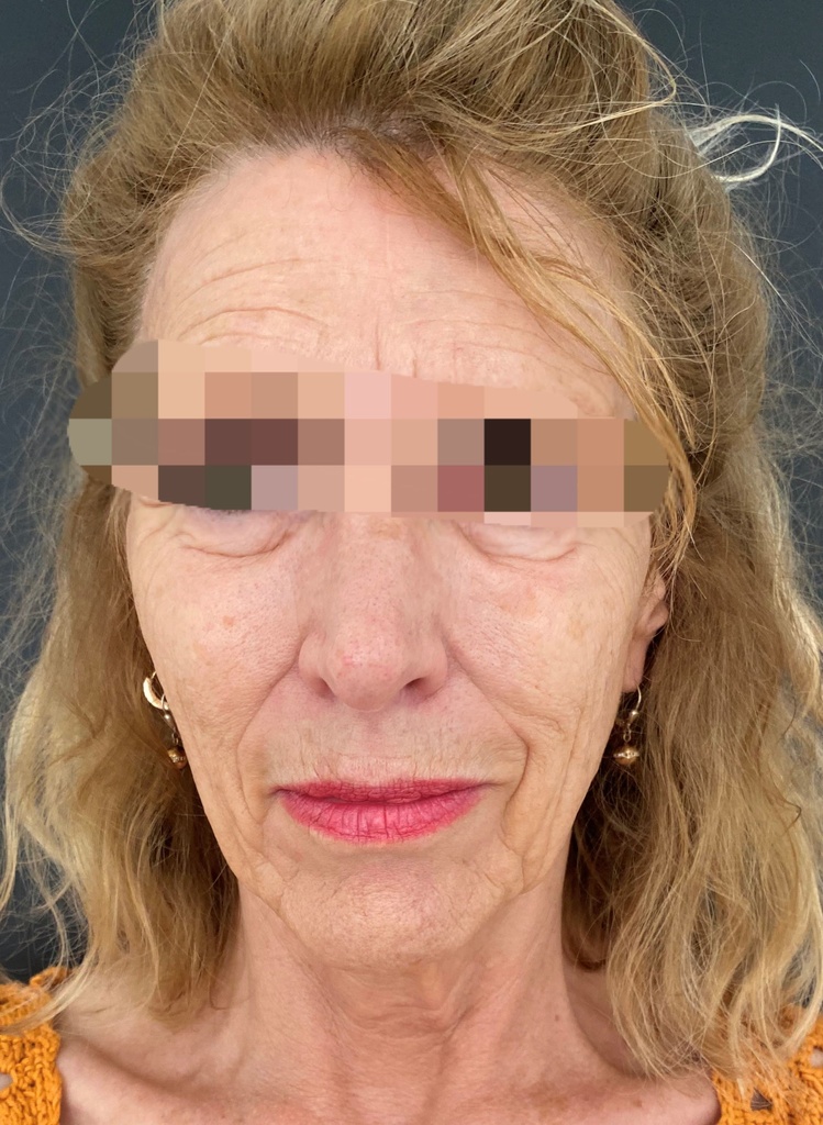 Avant injections d'acide hyaluronique 