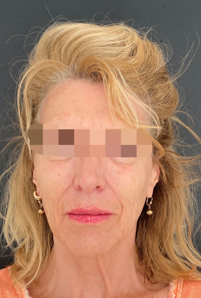 Apr&egrave;s injections La Clinique Laser
