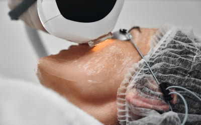 traitements au laser nice
